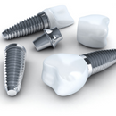 Dental implants